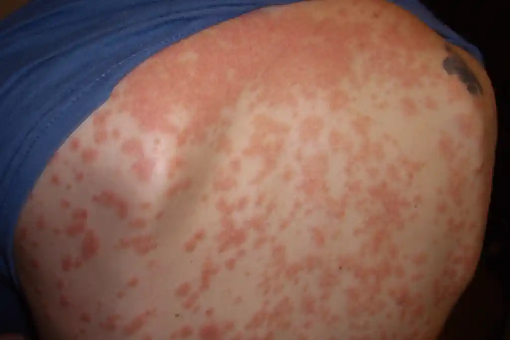 Psorijaza: Kompletan vodič kroz simptome, uzroke i metode liječenja